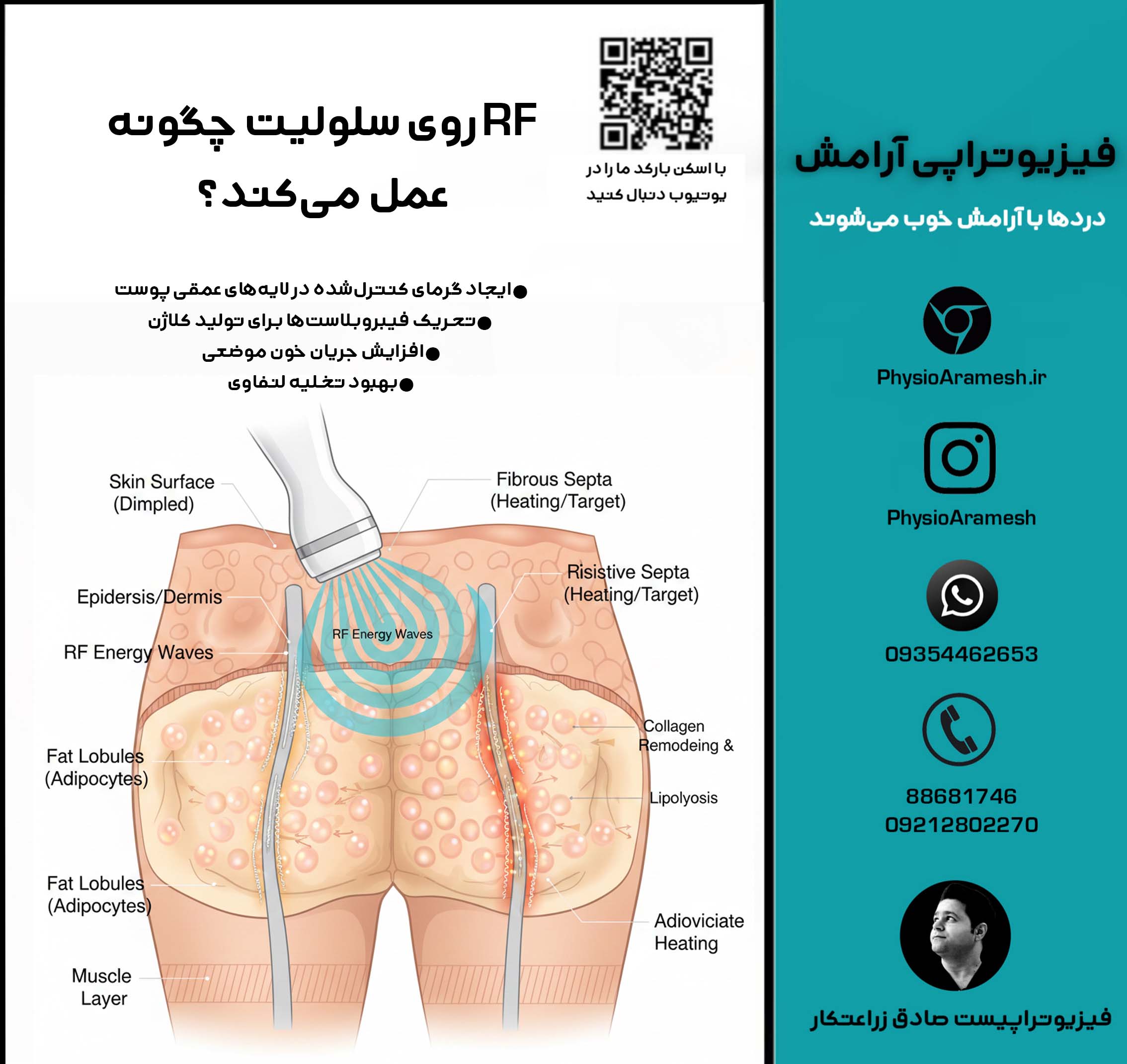 RF روی سلولیت چگونه عمل می‌کند؟